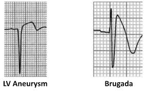 Image result for ST Elevation