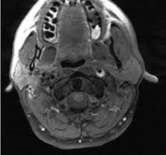 Isolated dissection of the internal carotid artery (ica) is rare in young patients and is a cause for strong suspicion of fibromuscular dysplasia (fmd), especially when associated with artery elongation and tortuosity. Internal Carotid Artery Dissection Radiology Reference Article Radiopaedia Org