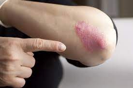 Ein ekzem ist eine reaktion der haut und verursacht rötung und juckreiz. Ekzem Dermatitis Symptome Verlauf Und Behandlungen
