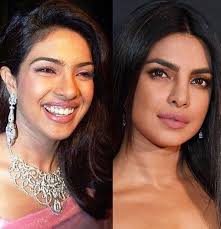 Priyanka Chopra Before And After Plastic Surgery Celebrity Plastic Surgery Nose Job Plastic Surgery Did priyanka chopra really have nose job?
