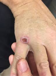 Image result for Pyoderma Gangrenosum