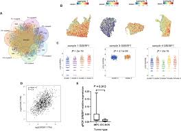 Spatial transcriptomics reveals gene expression characteristics in invasive  micropapillary carcinoma of the breast