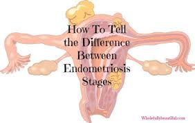 Bluehost Com Endometriosis Cure Endometriosis Endometriosis Stages