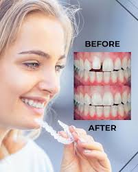 ✨ Discover the magic of clear aligners! It's not just about straight  teeth—it's renewed confidence and better oral health. 🦷😁 A radiant smile  can open doors, build connections, and leave lasting impressions.