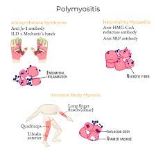 Image result for Polymyositis