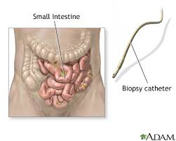 The removed tissue is examined for cancer or any other cell abnormalities. Small Intestine Biopsy Medlineplus Medical Encyclopedia Image