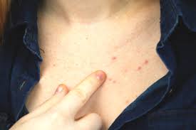 Untuk jerawat kadang mengalaminya, tapi yang sering adalah merasa gatal jika kulit kering. Muncul Jerawat Di Area Dada Yuk Lihat Penyebab Dan Cara Menanganinya Beauty Journal