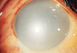 Er Can Be Mild Or Severe Alkali Tends To Penetrate The Cornea More Rapidly And Cause More Severe Corneal A Ulcer Causes Conjunctivitis Streptococcal Infection