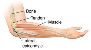 Select from 4,724 premium tendons of the highest quality. Understanding Lateral Epicondylitis Saint Luke S Health System