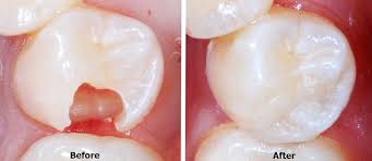 Dental fillings are the most common repair for holes in teeth caused by tooth decay. Fillings Dentist On Main Dentist Cape Town