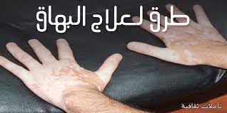 علاج البرص افضل علاج مستخدم لعلاج البرص المنام
