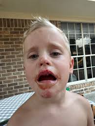 Boo boo salve heals child's injuries