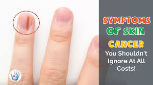 Find facts and statistics for reporting about skin cancer. 10 Symptoms Of Skin Cancer Youtube