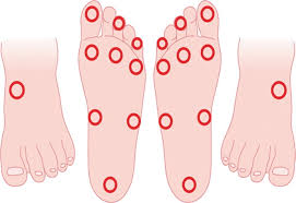 Diabetic foot ulcers are a growing problem in the diabetic community. Diabetic Foot Syndrome Risk Factors Clinical Assessment And Advances In Diagnosis Springerlink