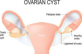 Learn more about ovarian cancer and ovarian cancer does have symptoms, but they are often very subtle and easily mistaken for other, more common problems. Ovarian Cysts Honorhealth