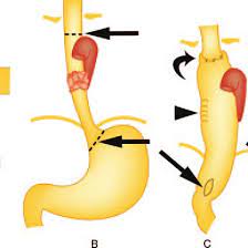 The surgery involves small incisions through which surgeons insert a tiny camera and can remove cancerous parts of the esophagus and stomach. Drawings Illustrate Transthoracic Esophagectomy With A Laparotomy And A Download Scientific Diagram