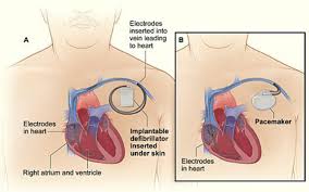 When the pulse's magnetic field collapses, causing the reflected pulse, the magnetic field of the object makes it take but if you yell into a room with a lot of hard surfaces, the echo lasts longer. 5 Personal Implants And Medical Devices Airport Passenger Screening Using Millimeter Wave Machines Compliance With Guidelines The National Academies Press