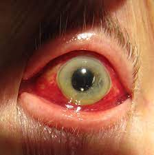 It may look and sound like a serious health issue, but that's not always the case. Subconjunctival Bleeding Wikipedia