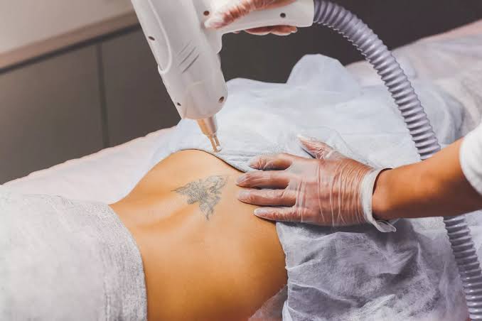 Laser Tattoo Removal - Medical Spa Services - Santa Rosa