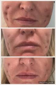 Have my threads been pulled too tight