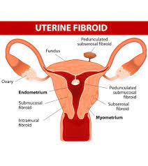 We did not find results for: 5 Best Treatments For Uterine Fibroids During Pregnancy