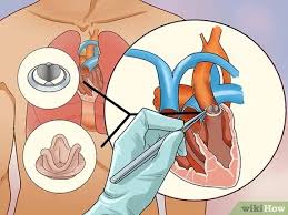 It's easy to fear the worst when your doctor tells you that he hears a murmur in your. How To Treat An Adult Heart Murmur 9 Steps With Pictures