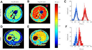 Bile is a mixture of water, bile salts, cholesterol, and the pigment bilirubin. 3d Molecular Mr Imaging Of Liver Fibrosis And Response To Rapamycin Therapy In A Bile Duct Ligation Rat Model Journal Of Hepatology