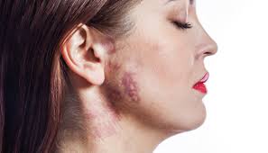 Port-Wine Stain | Johns Hopkins Medicine