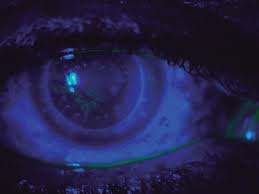 Maybe you would like to learn more about one of these? Scielo Brasil The Outcome Of Penetrating Keratoplasty For Corneal Scarring Due To Herpes Simplex Keratitis The Outcome Of Penetrating Keratoplasty For Corneal Scarring Due To Herpes Simplex Keratitis