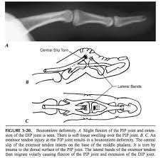 Image result for Elson Extensor Tendon Test