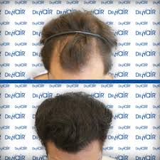 Dr Hair Hair Transplantation Turkey Sac Ekimi Sac Dokulme Tedavileri Sac Dokulmesi Sac