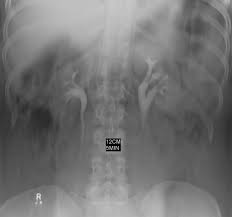Learn more about the renal pelvis in this article. Bifid Renal Pelvis On Ivp Radiology Case Radiopaedia Org