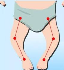 Image result for Pediatric Leg Disorder