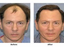 Another picture of hair cloning bernstein: Hair Transplant Amta Health
