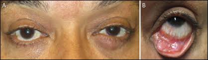 Maybe you would like to learn more about one of these? Man Presents With Rapidly Growing Eyelid Lesion
