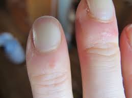 Image result for Chilblains