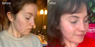 Hormonal acne appears primary where your androgen receptors are (chin and jawline), but can occur on the sides of your face and down your neck as well.though there's no scientific evidence that dim supplements fix or cure hormonal acne, cheung says they can help. Hhw7a9jx4rkgem