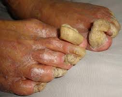 Image result for Onychogryphosis feet