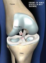 But even in a sport where most are able to return, performance can be affected. Acl Injuries Are The Most Common Sports Related Knee Injury They Are Caused When The Knee Is Hyper Extended Cruciate Ligament Cruciate Ligament Tear Acl Tear
