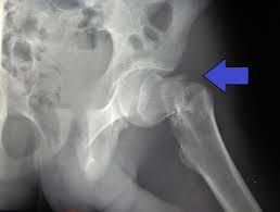 Hip fracture 