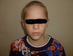 Fenilcetonuria. Presentación de caso