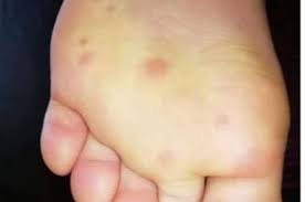 Lesi Merah Dan Rasa Gatal Di Kaki Gejala Baru Positif Virus Corona Semua Halaman Grid Health