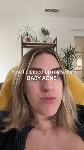 Mi Bebé Tiene Acné Neonatal Puedo Comer