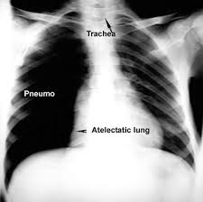 Image result for Atelectasis