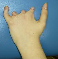 Among those who have poland syndrome, 75% have symptoms on the right hand side of their body. Poland Syndrome Hand Orthobullets
