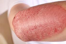 Ramai mereka kulit psoriasis masih belum tahu perkara ini. Rawatan Untuk Psoriasis Ubat Ubatan Salap Dan Pilihan Semula Jadi Lembu 2021