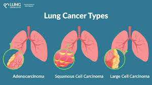 Image result for Lung Cancer