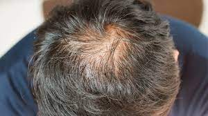 La caduta di capelli in condizioni normali è da ritenersi un naturale processo fisiologico di ricambio della capigliatura. 7 Rimedi Contro La Caduta Dei Capelli Nel 2020 Prima Treviglio