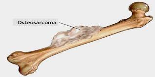 A report from the childrens oncology group bone tumor committee. Osteosarcoma Assignment Point