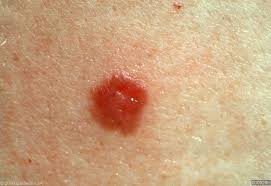 Some types of skin cancer are more dangerous than others, but if you have a spot. About Skin Cancer Mobile Skin Doctors